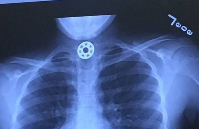 5 самых странных предметов, проглоченных человеком: рентгеновские снимки