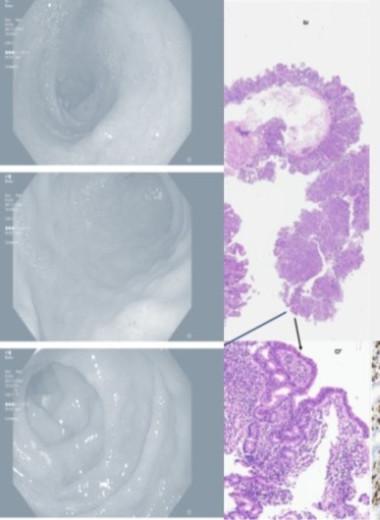 Лекарство от давления вызвало энтеропатию и диарею у пожилой итальянки