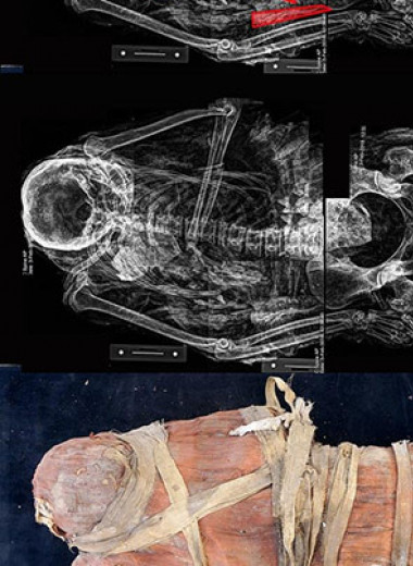 В Египте нашли мумию парализованной после инсульта женщины