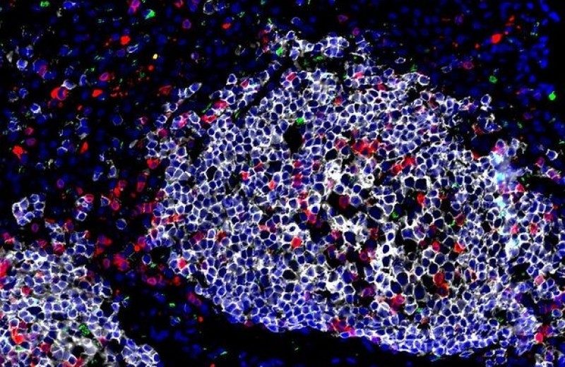 Стволовые клетки в легких приютили туберкулезные бактерии