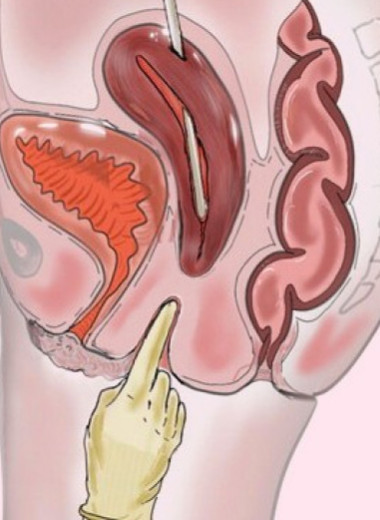 Британка без шейки матки и влагалища забеременела естественным путем после реконструктивной операции