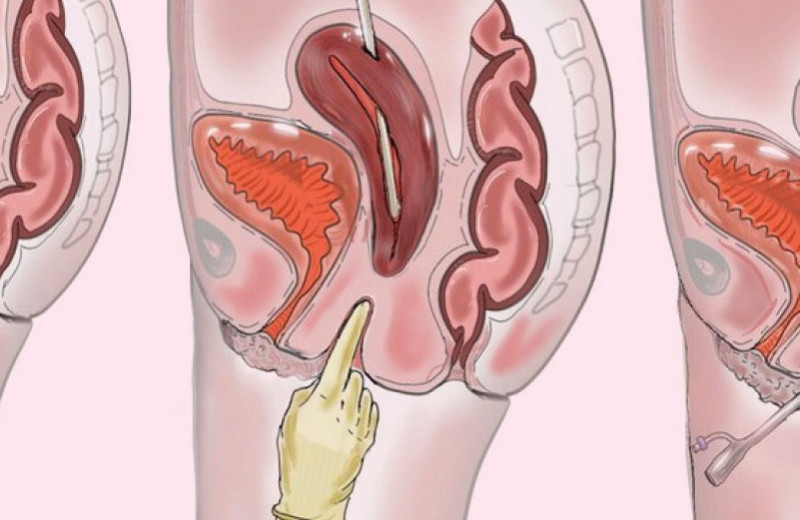 Британка без шейки матки и влагалища забеременела естественным путем после реконструктивной операции