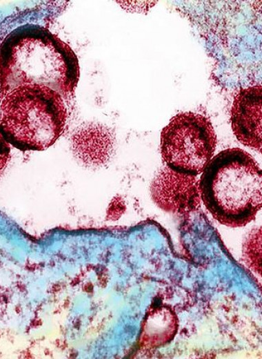 У ВИЧ-инфицированной пациентки заподозрили естественное избавление от вируса