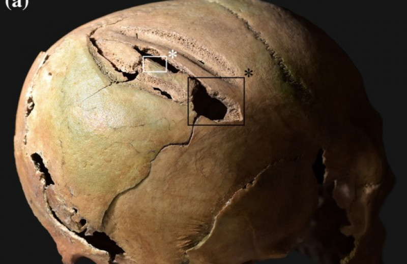 На черепе средневекового венгерского конного лучника нашли следы незавершенной трепанации