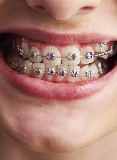 Как раньше люди жили без брекетов и не жаловались на прикус?