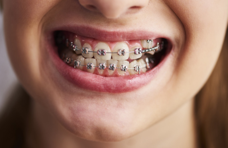 Как раньше люди жили без брекетов и не жаловались на прикус?