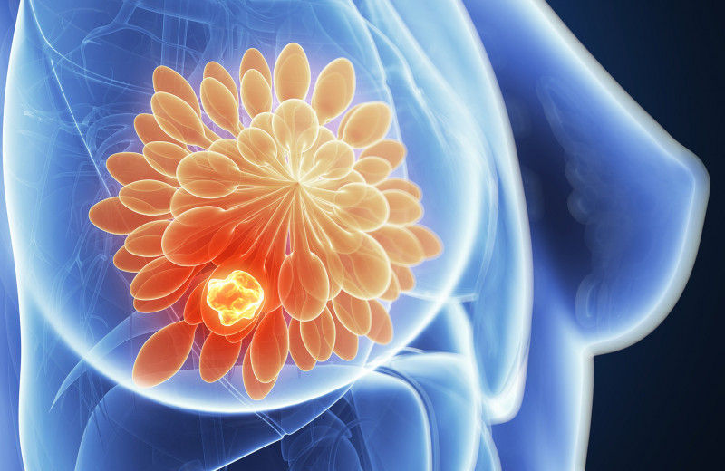 Красные пятна, зуд, морщины: 7 признаков рака груди, которые часто игнорируют