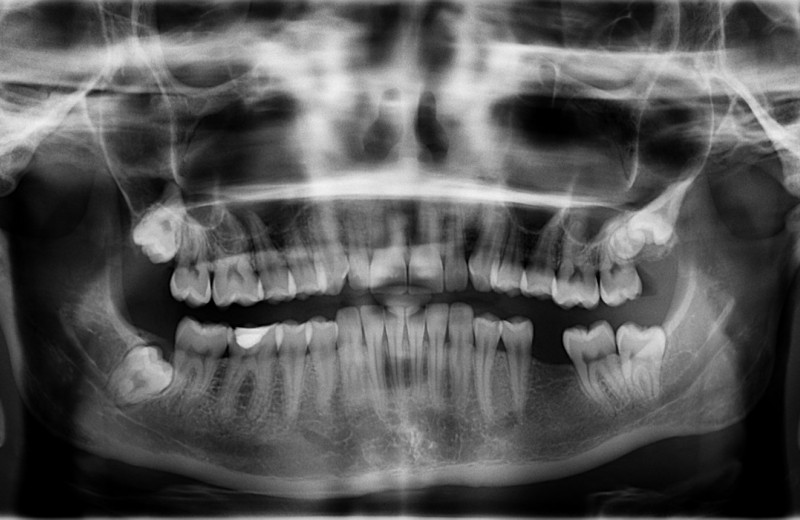 Почему зубы не считаются костью