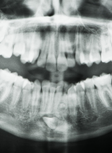 Улыбаться во все 42: мужчина попал в Книгу рекордов Гиннесса за аномальное большое количество зубов
