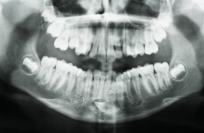 Улыбаться во все 42: мужчина попал в Книгу рекордов Гиннесса за аномальное большое количество зубов