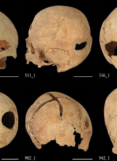 Трепанация черепа в средневековой Франции оказалась методом лечения неврологических расстройств