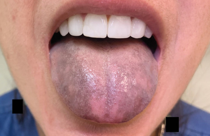 Антитела к ферменту синтеза стероидов привели к посинению языка у американки