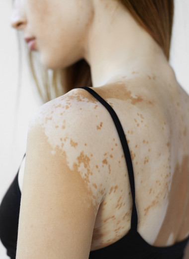 Меланин: от чего зависит пигментация кожи и помогут ли таблетки