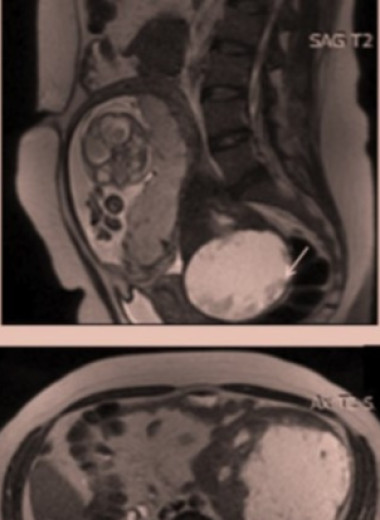 Две огромные опухоли в животе у беременной итальянки оказались лейомиомами