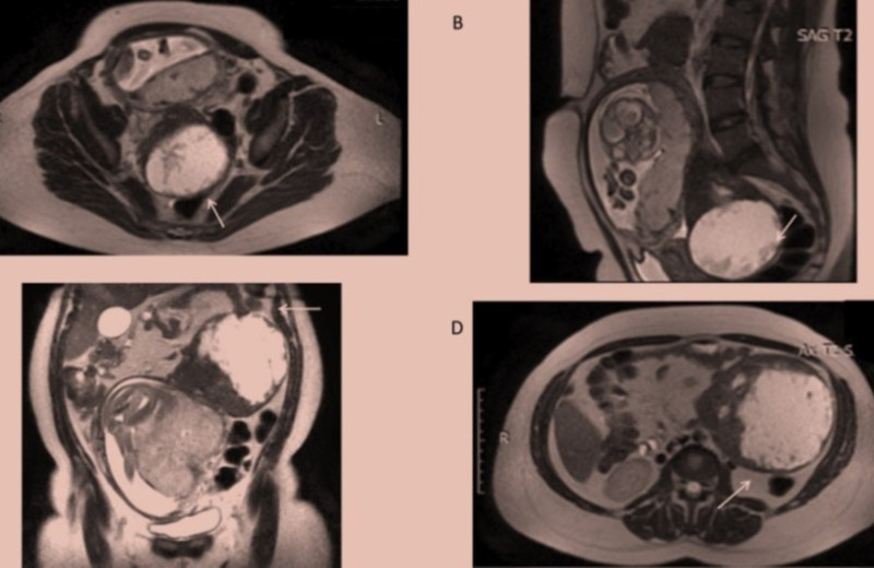 Две огромные опухоли в животе у беременной итальянки оказались лейомиомами