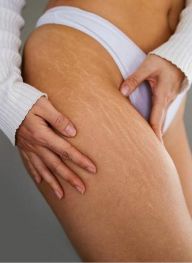 Растяжки на коже у женщин: почему они появляются и как от них избавиться