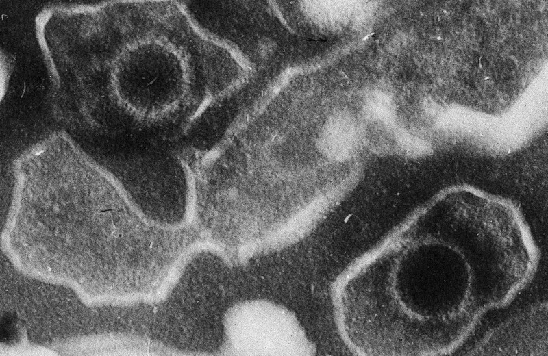 Широко распространенный вирус может вызывать рассеянный склероз