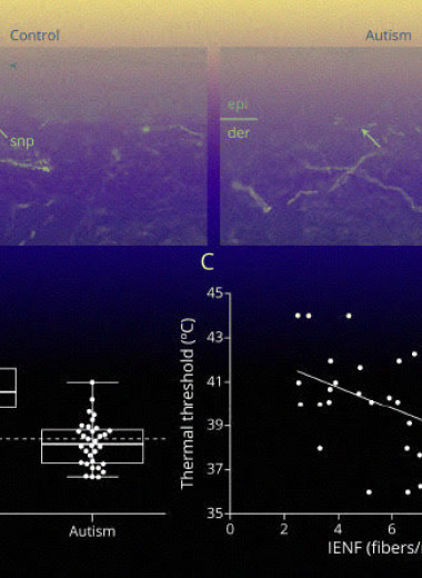 Тонкие нервные волокна не позволили людям с аутизмом ощутить тепло