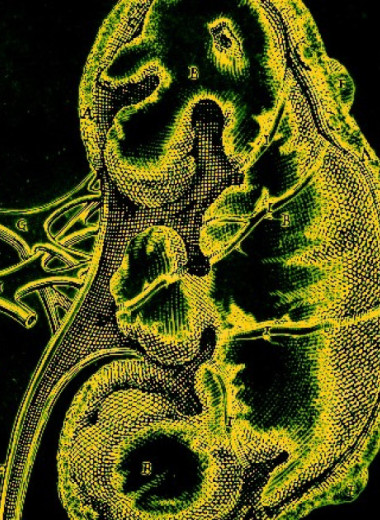 Вода и диета с лекарствами снизили вероятность повторного образования камней в почках