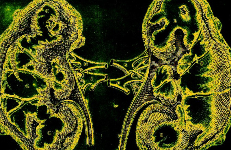 Вода и диета с лекарствами снизили вероятность повторного образования камней в почках