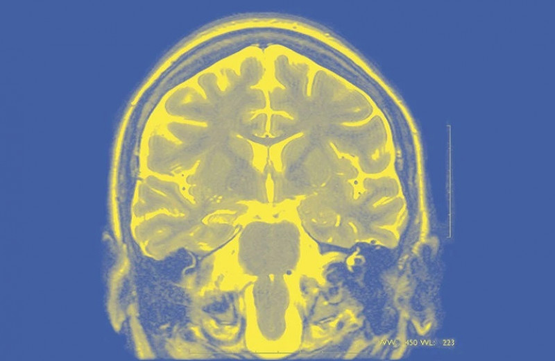Виртуальная модель мозга поможет нейрохирургам лечить эпилепсию