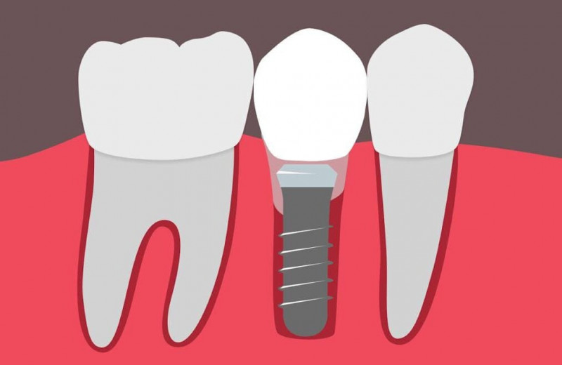 Чем грозит отсутствие зуба, и почему «мосты» и протезы не спасают от деформации челюсти