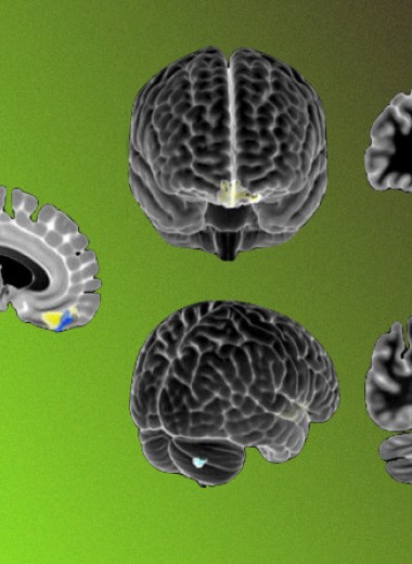 Нарушения мозжечково-корковых путей связали с аутистическим поведением
