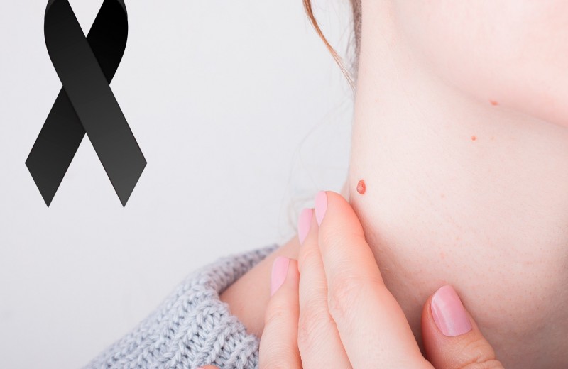 Меланома кожи: как распознать и лечить рак