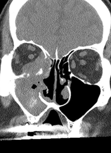 Распространенность грибкового синусита среди людей с иммунодефицитами выросла почти вдвое