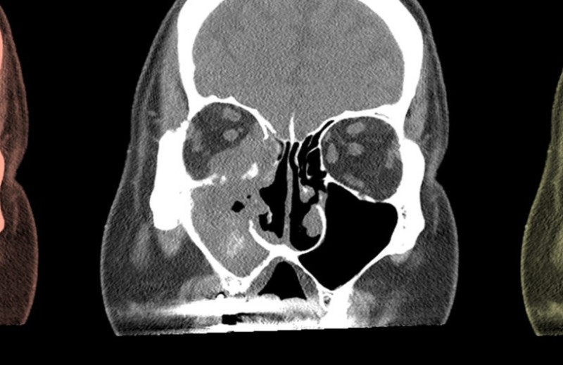 Распространенность грибкового синусита среди людей с иммунодефицитами выросла почти вдвое