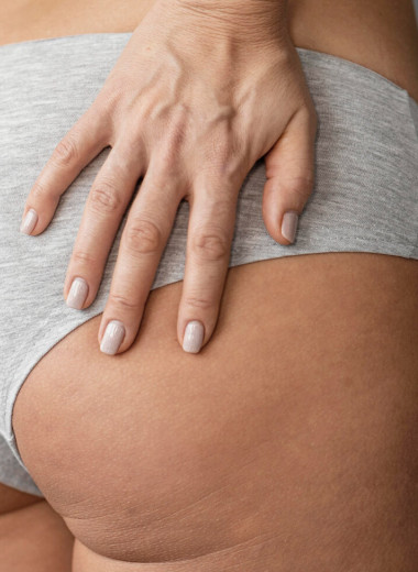 Откуда берется целлюлит и нужно ли с ним бороться