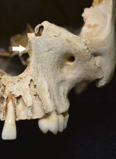 Антропологи нашли на Карибах череп старейшего прокаженного Америки