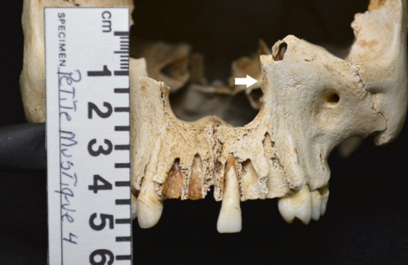 Антропологи нашли на Карибах череп старейшего прокаженного Америки