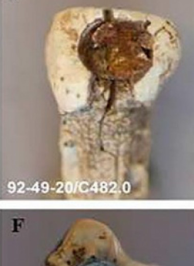 Майя классического периода закрепили украшения на зубах с помощью смолы и битума