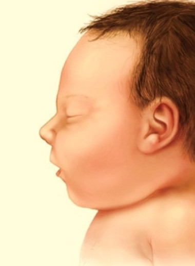 Врожденная вирусная инфекция Зика повысила риск госпитализации из-за эпилепсии у детей