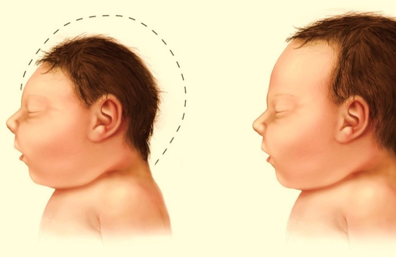 Врожденная вирусная инфекция Зика повысила риск госпитализации из-за эпилепсии у детей