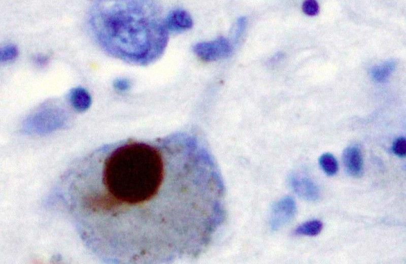 T-клетки указали на болезнь Паркинсона до появления симптомов