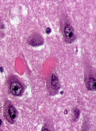 Вторая Х-хромосома смягчила болезнь Альцгеймера у мышей