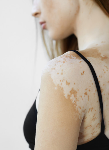 Меланин: что это и как влияет на пигментацию кожи