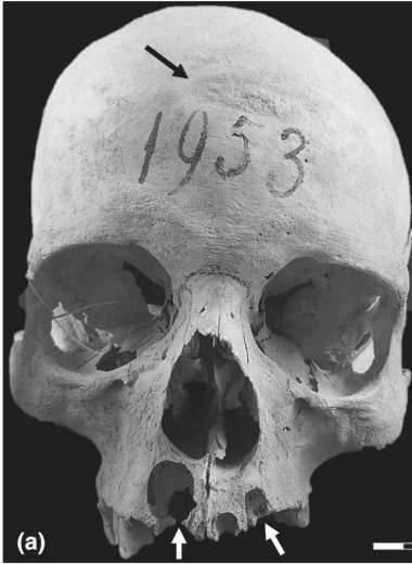 При жизни дважды вскрыли череп: жуткая история находки из некрополя лангобардов