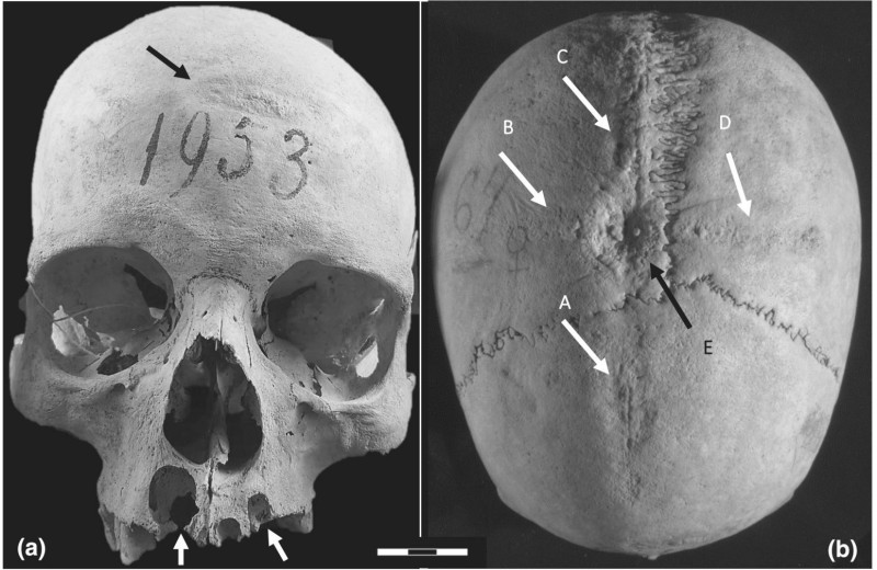 При жизни дважды вскрыли череп: жуткая история находки из некрополя лангобардов