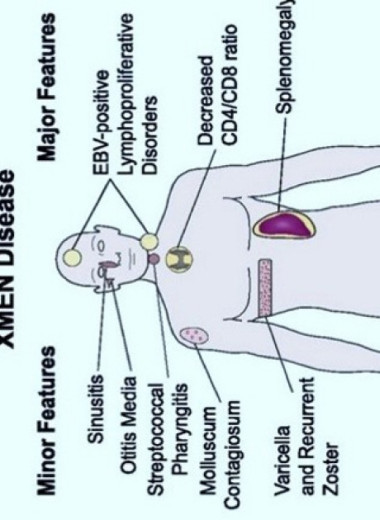 Врачи вылечили болезнь XMEN пересадкой костного мозга