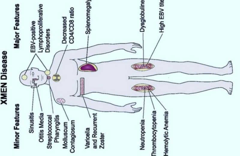 Врачи вылечили болезнь XMEN пересадкой костного мозга