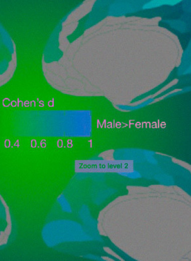 Дисбаланс активности мозга при аутизме связали с половыми различиями