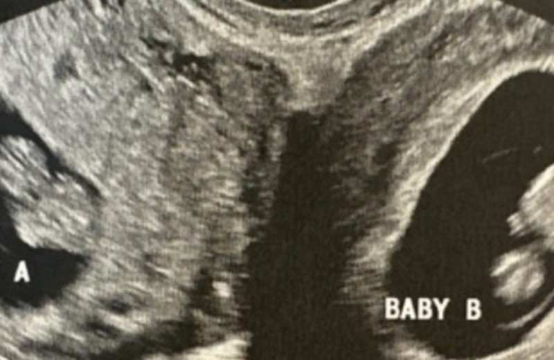 У американки с двумя матками выявили беременность в обеих