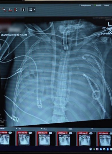 Аппарат двое суток поддерживал нормальную жизнедеятельность американца без легких