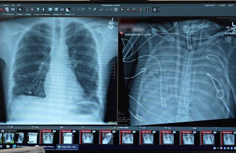 Аппарат двое суток поддерживал нормальную жизнедеятельность американца без легких