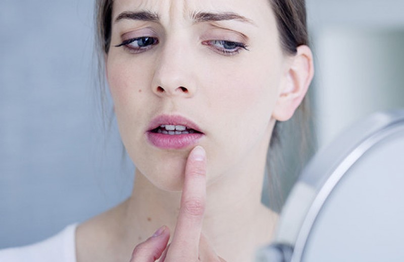 Сама себе лекарь: как быстро вылечить простуду на губе