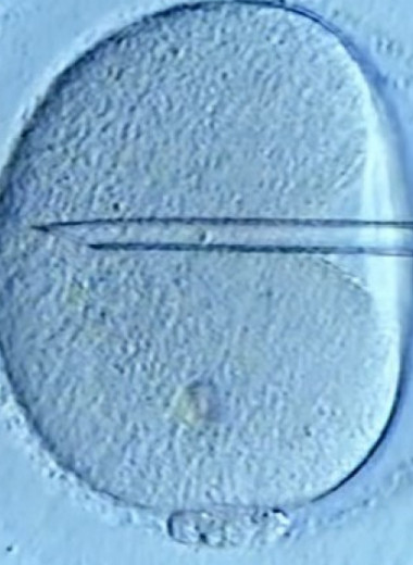 Репродуктивные технологии оказались не связаны с ростом общей частоты рака у женщин