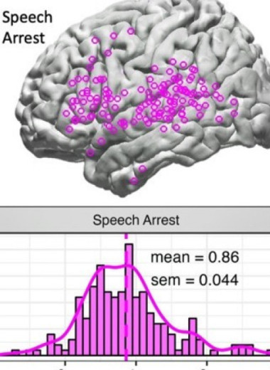 Стимуляция вентральных областей соматосенсорной коры привела к отсроченной остановке речи